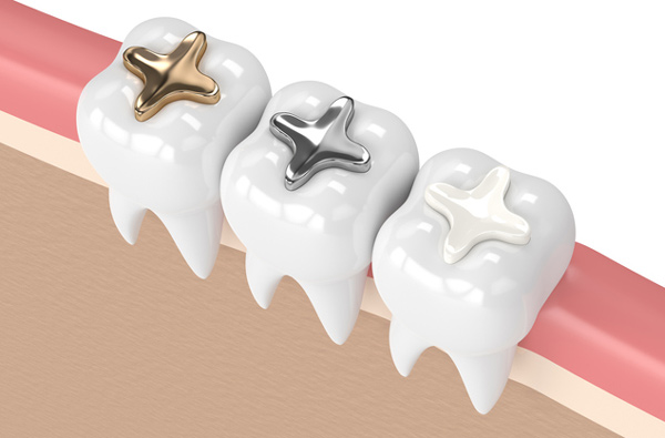 Rendering of teeth with 3 filling materials in New York, NY