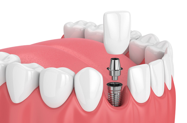 Rendering of jaw with dental implant New York, NY Rendering of jaw with dental implant New York, NY