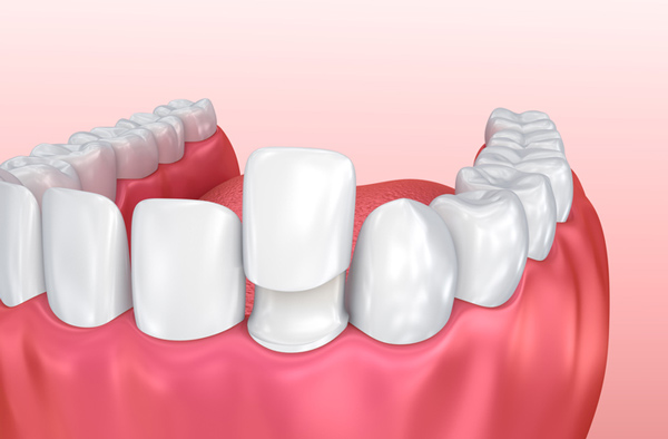 Rendering of jaw with porcelain veneer on tooth in New York, NY