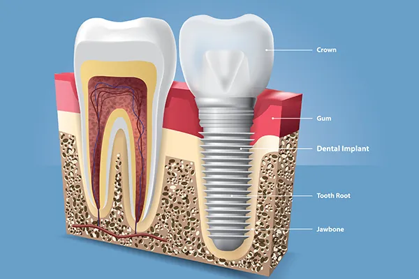 A labeled cross-section of a dental implant, showing the crown, abutment, post, and integration into the jawbone.